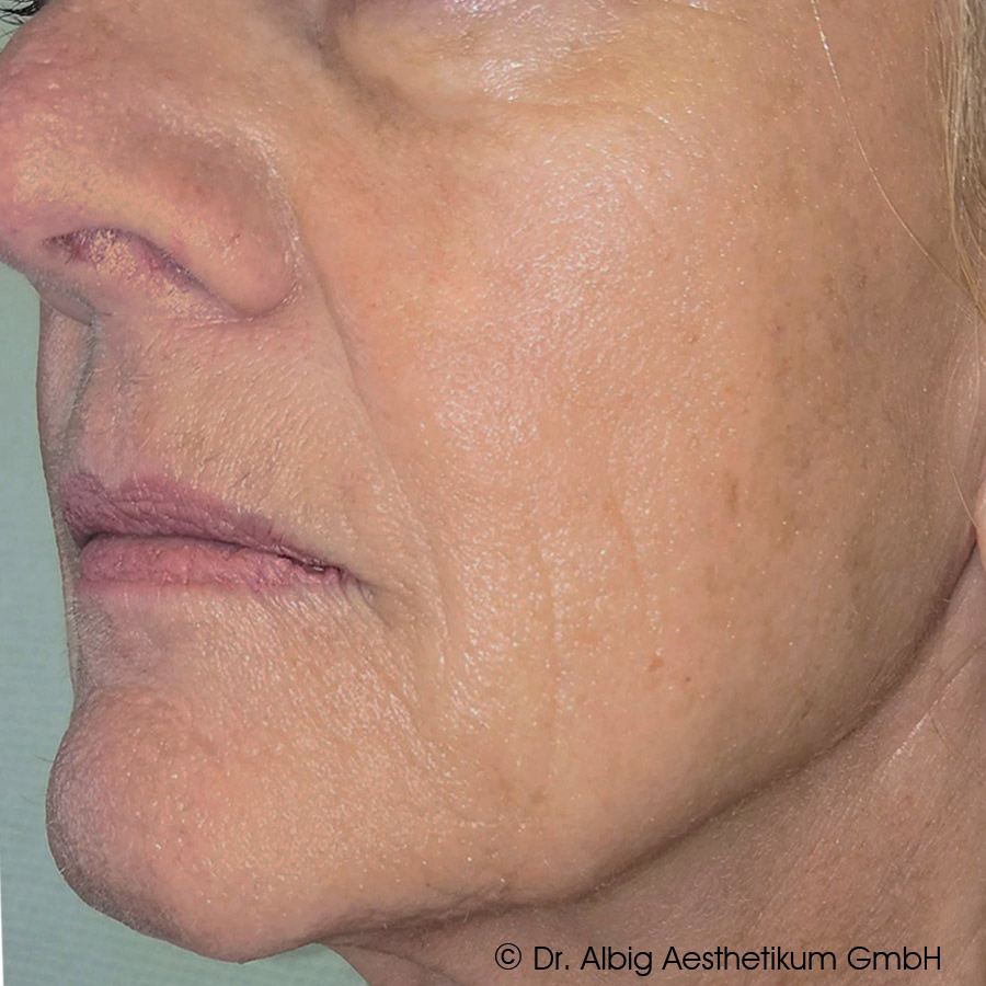 DoubleTite Ergebnis nach 2 Behandlung(en) mit 1 ml Skinbooster je Behandlung