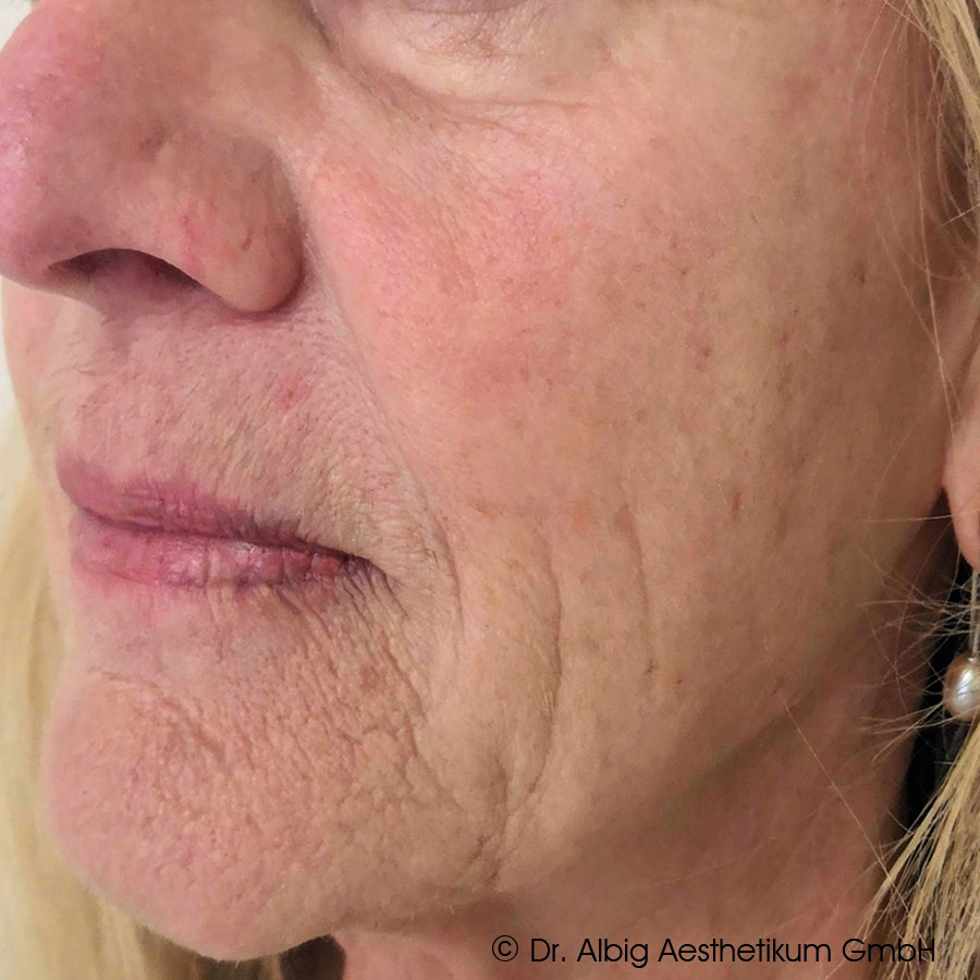 Ausgangszustand vor DoubleTite Behandlung mit 1 ml Skinbooster je Behandlung