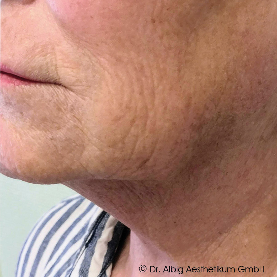 DoubleTite Ergebnis nach 3 Behandlung(en) mit 1 ml unvernetzte Hyaluronsäure