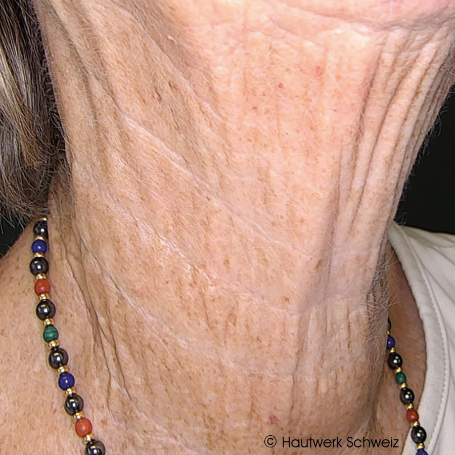 DoubleTite Ergebnis nach 1 Behandlung(en) mit 1 ml unvernetzte Hyaluronsäure
