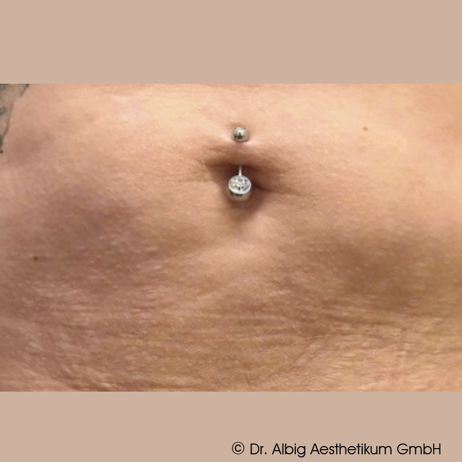 DoubleTite Ergebnis nach 2 Behandlung(en) mit 1 ml unvernetzte Hyaluronsäure je Behandlung