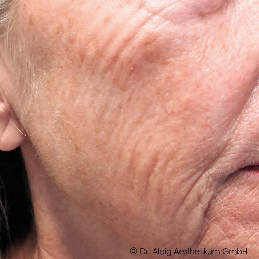 DoubleTite Ergebnis nach 2 Behandlung(en) mit 1 ml unvernetzte Hyaluronsäure je Behandlung