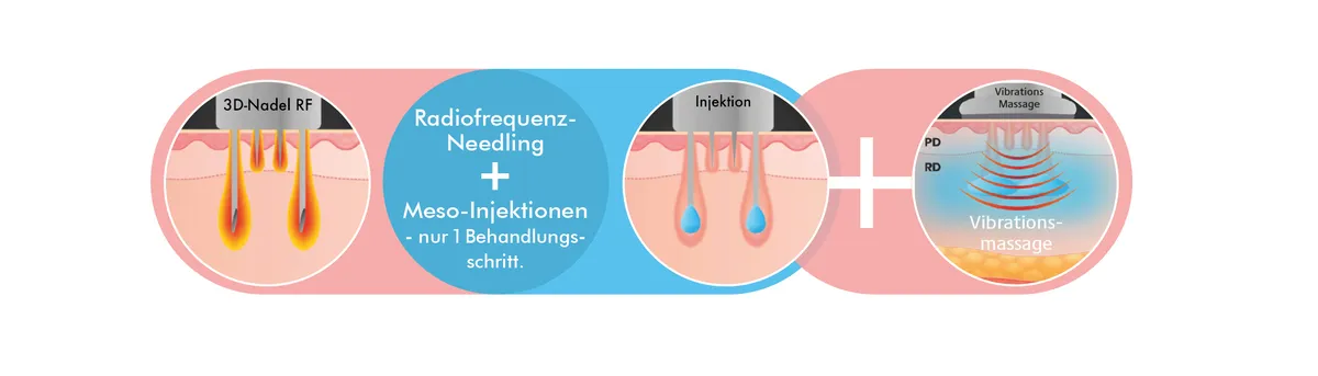 DoubleTite – 3D-Nadel RF, Injektion, Vibrationsmassage